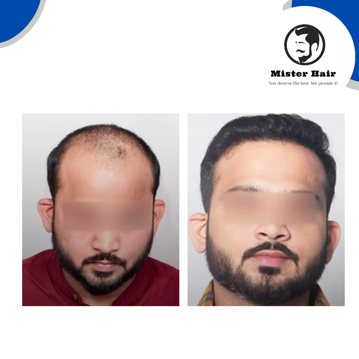 DHI Hair Transplant Result - 9 Months