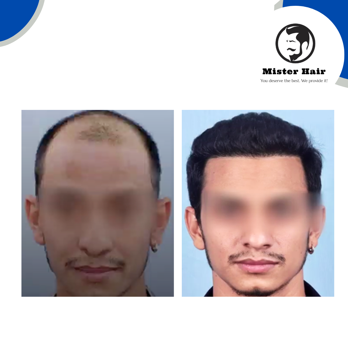 DHI Hair Transplant - Before/After Comparison