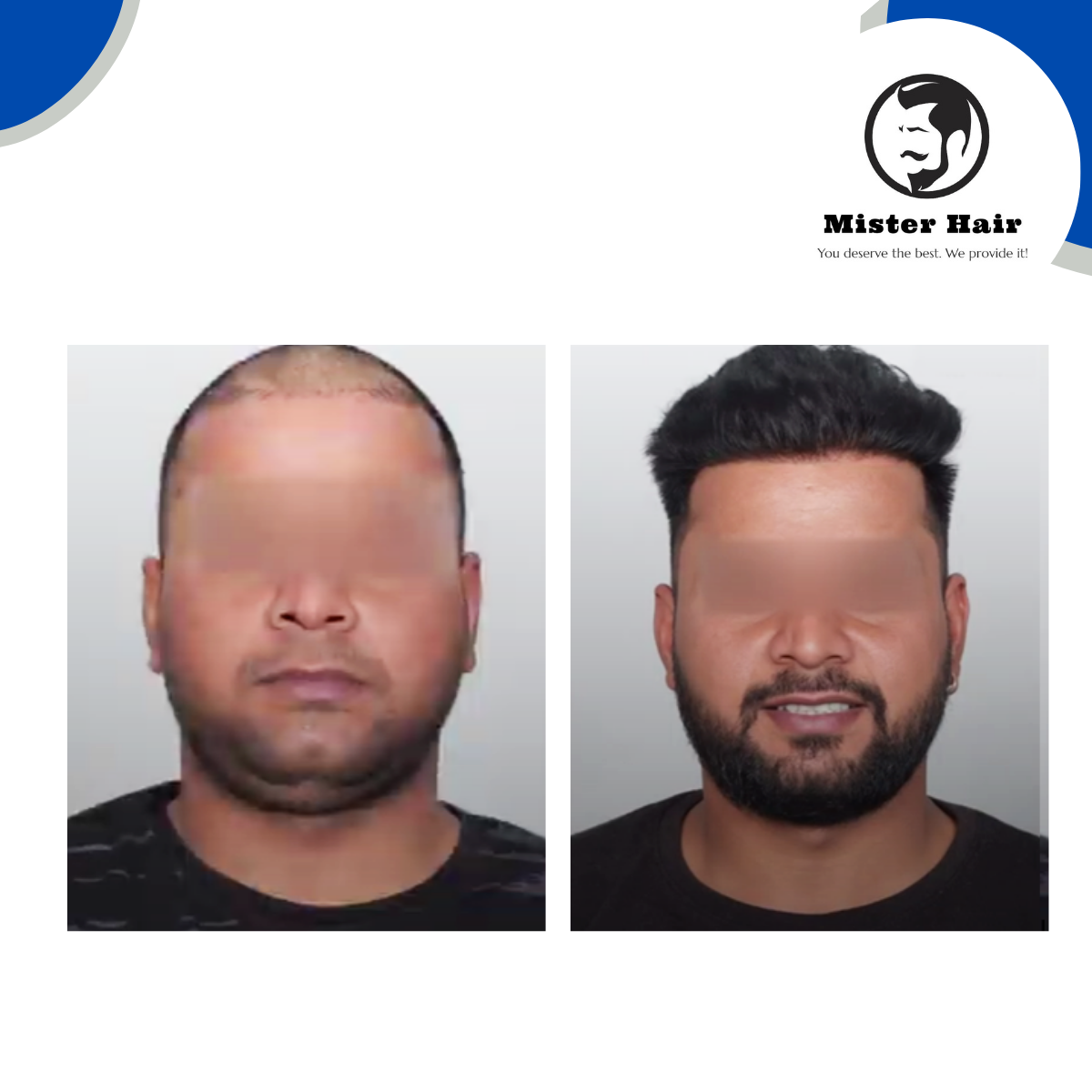 DHI Hair Transplant Result - 12 Months
