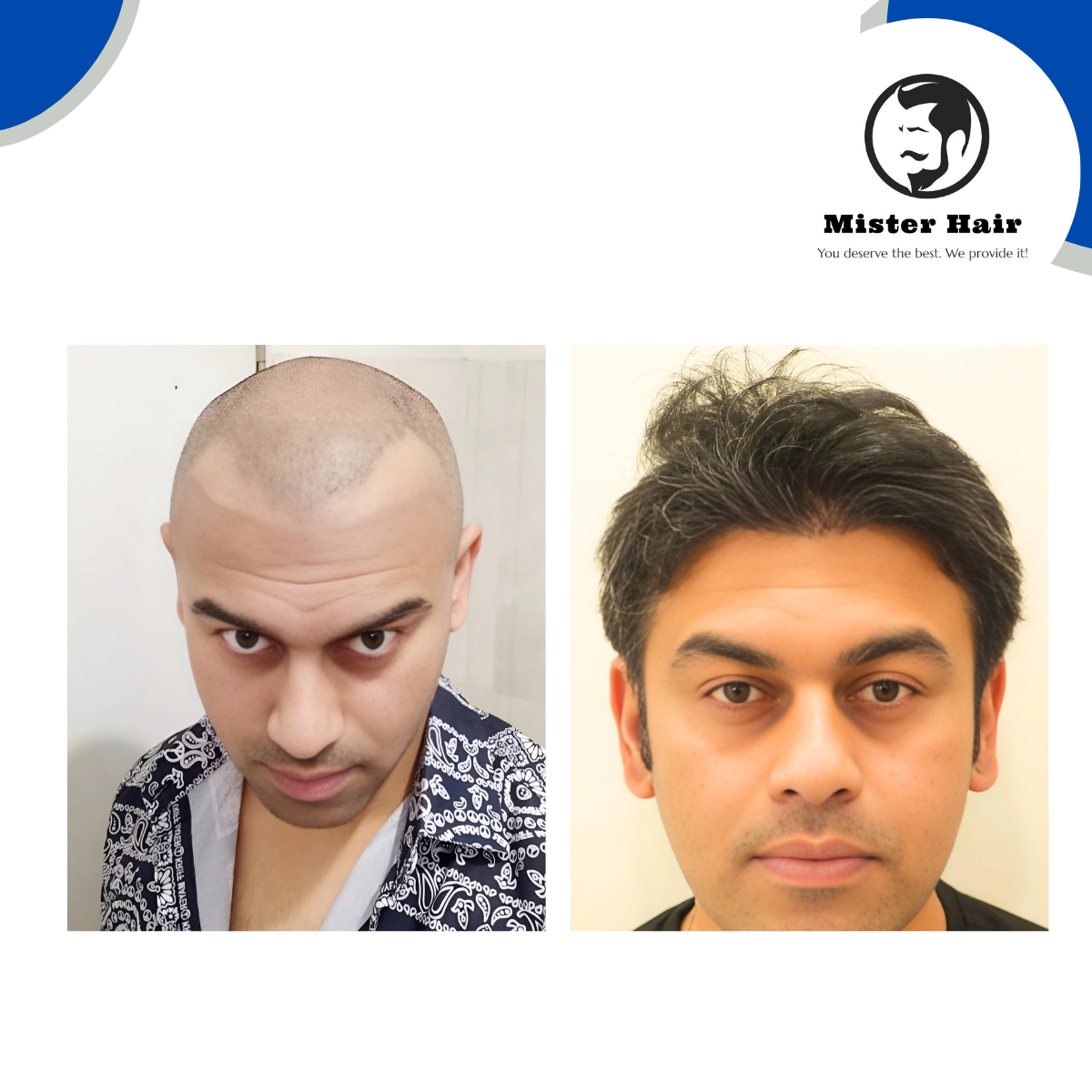 DHI Hair Transplant Result - 6 Months