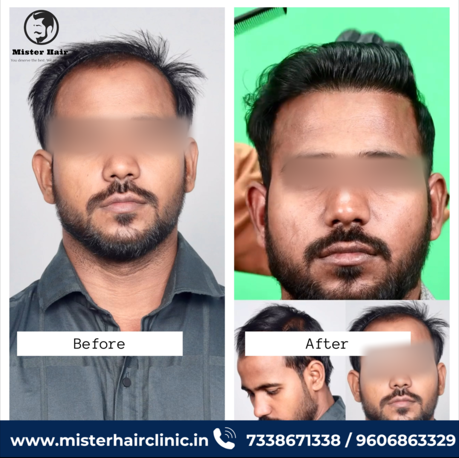 Best Hair Clinic In Bangalore Hair Treatment Doctors In Bangalore best-hair-clinic-in-bangalore-hair-treatment-doctors-in-bangalore