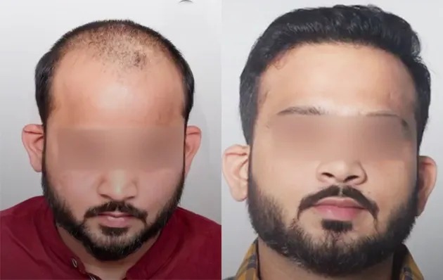 Hair Transplant (DHI/Sapphire)