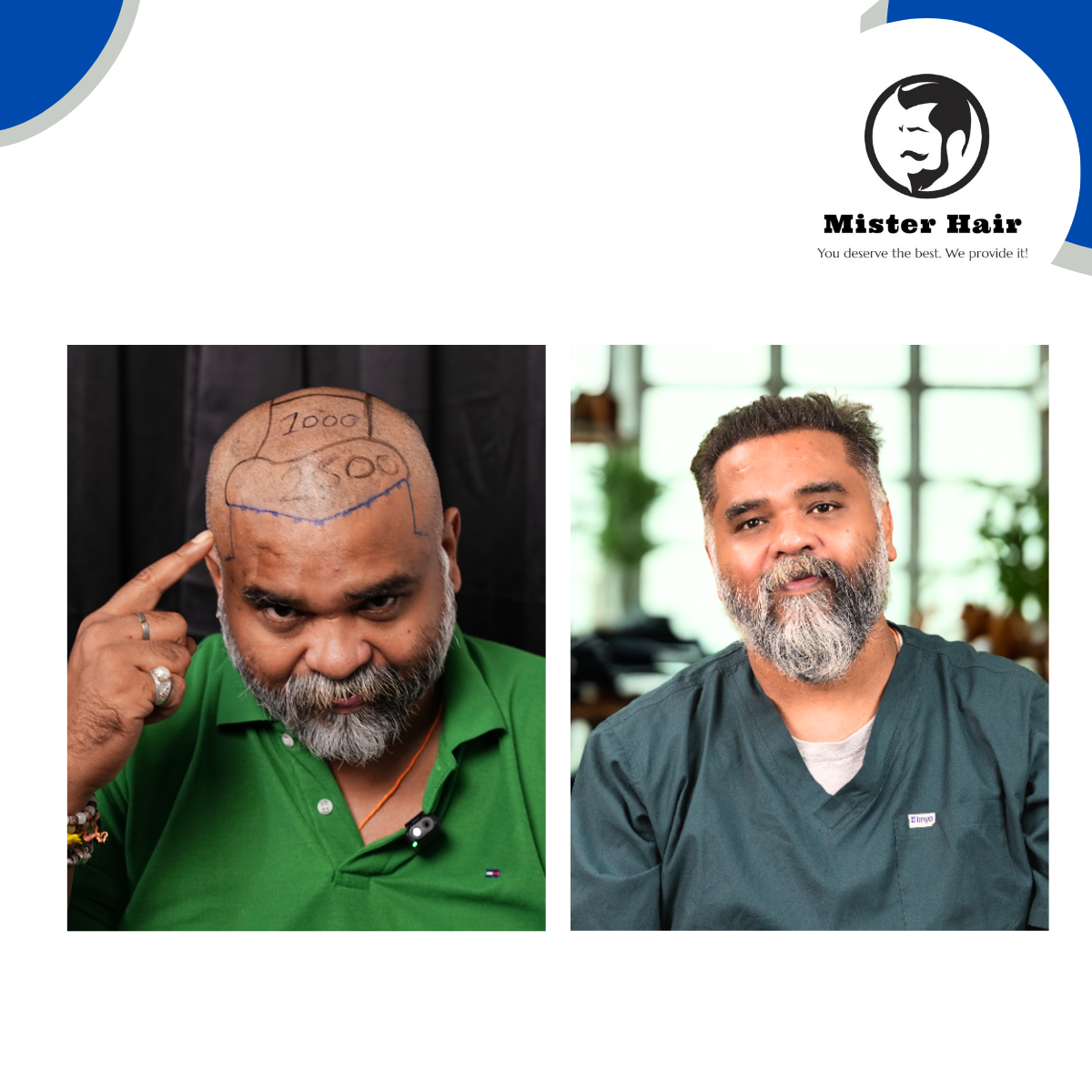 Best Hair Transplant Doctor in Bangalore 2025