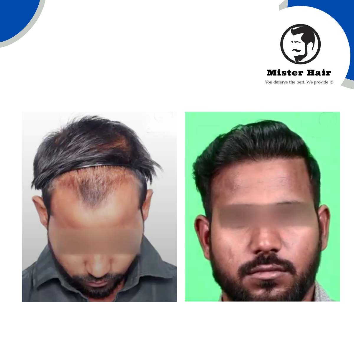 Sapphire vs DHI Transplant: Which Is Best for Natural Hairlines?