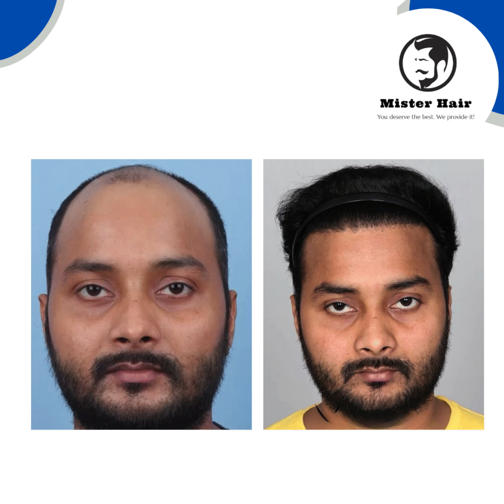 Hair Transplant Clinic in Sadashivanagar, Bengaluru – Restore Your Hair