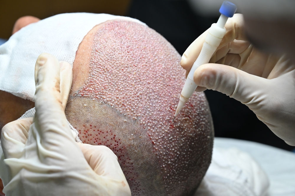 Hair Transplant FAQs: 15 Questions Every Patient Asks