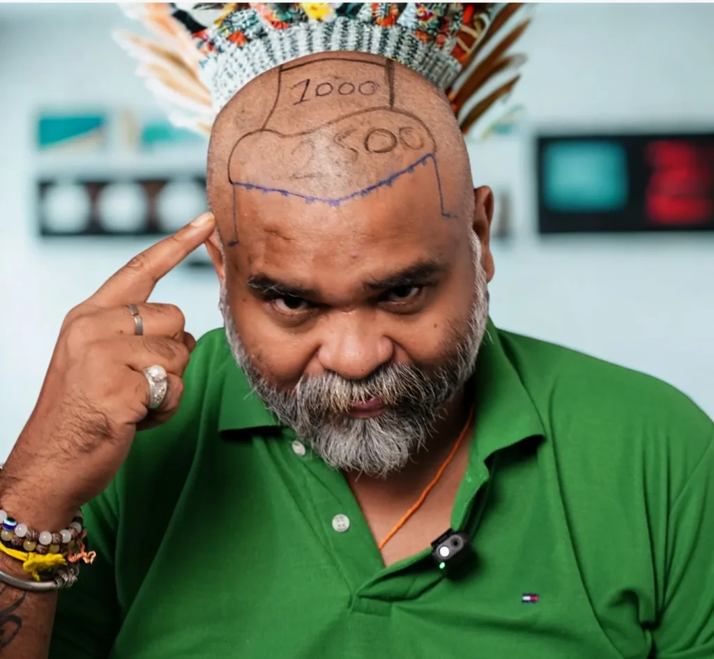 Top 10 Hair Transplant Clinics in Bangalore (2025 Updated List)