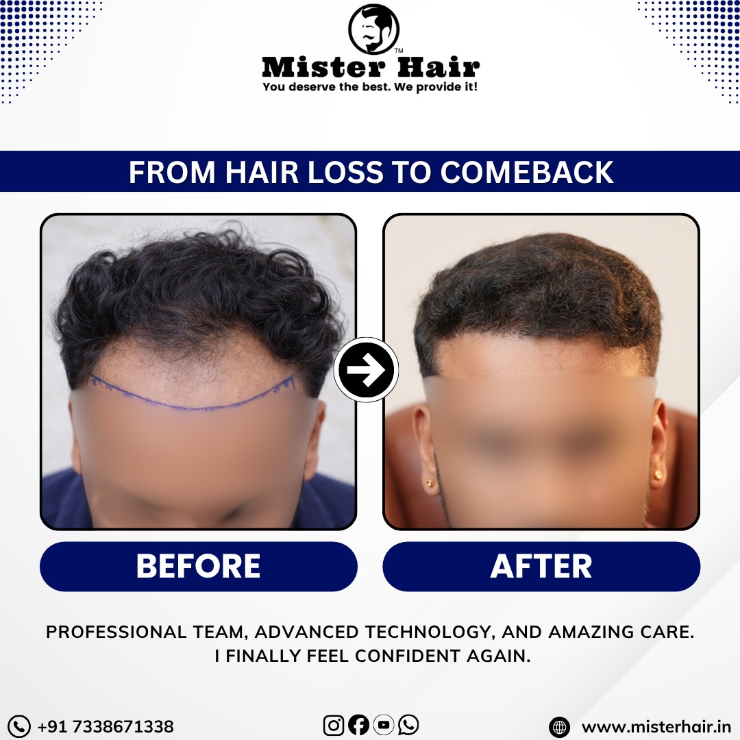 MCT Autologous Exosomes