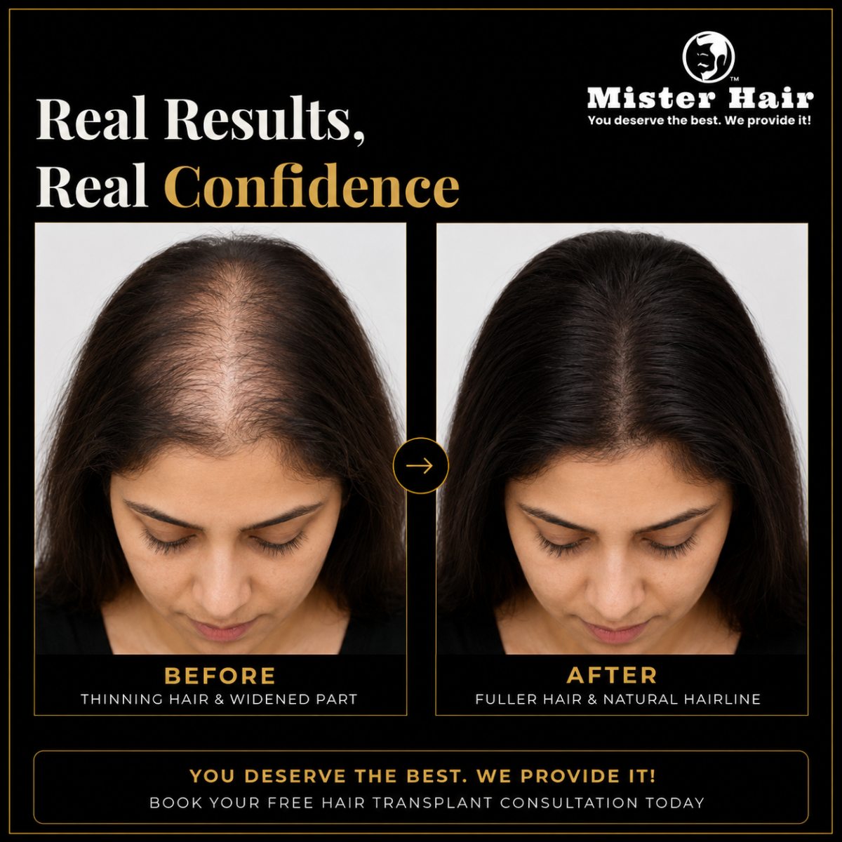 Female Hair Loss Treatment in Bangalore