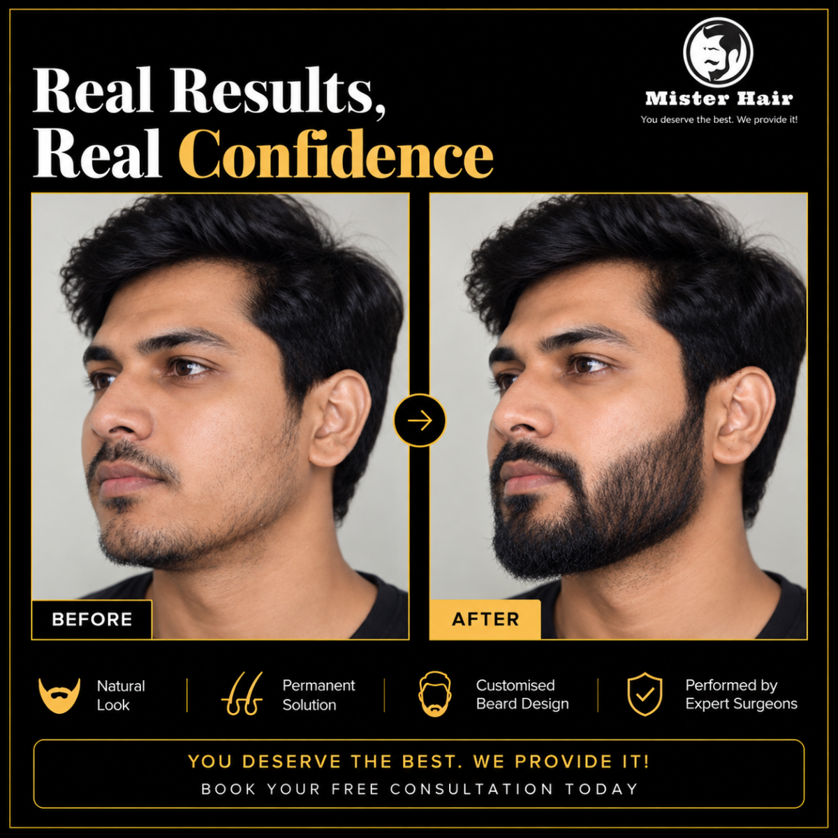 Beard & Eyebrow Transplant in Bangalore