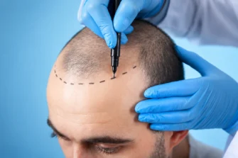 Hair transplant in HRBR Layout