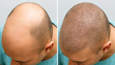 Hair transplant in Sadashiv Nagar
