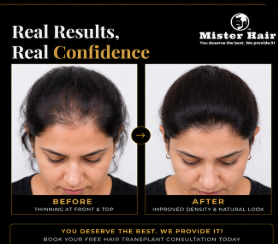 Female Hair Loss Treatment in Bangalore before and after result 2