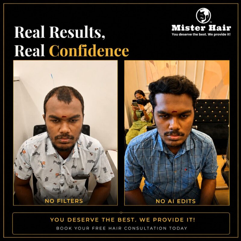 Hair transplant before and after result 2