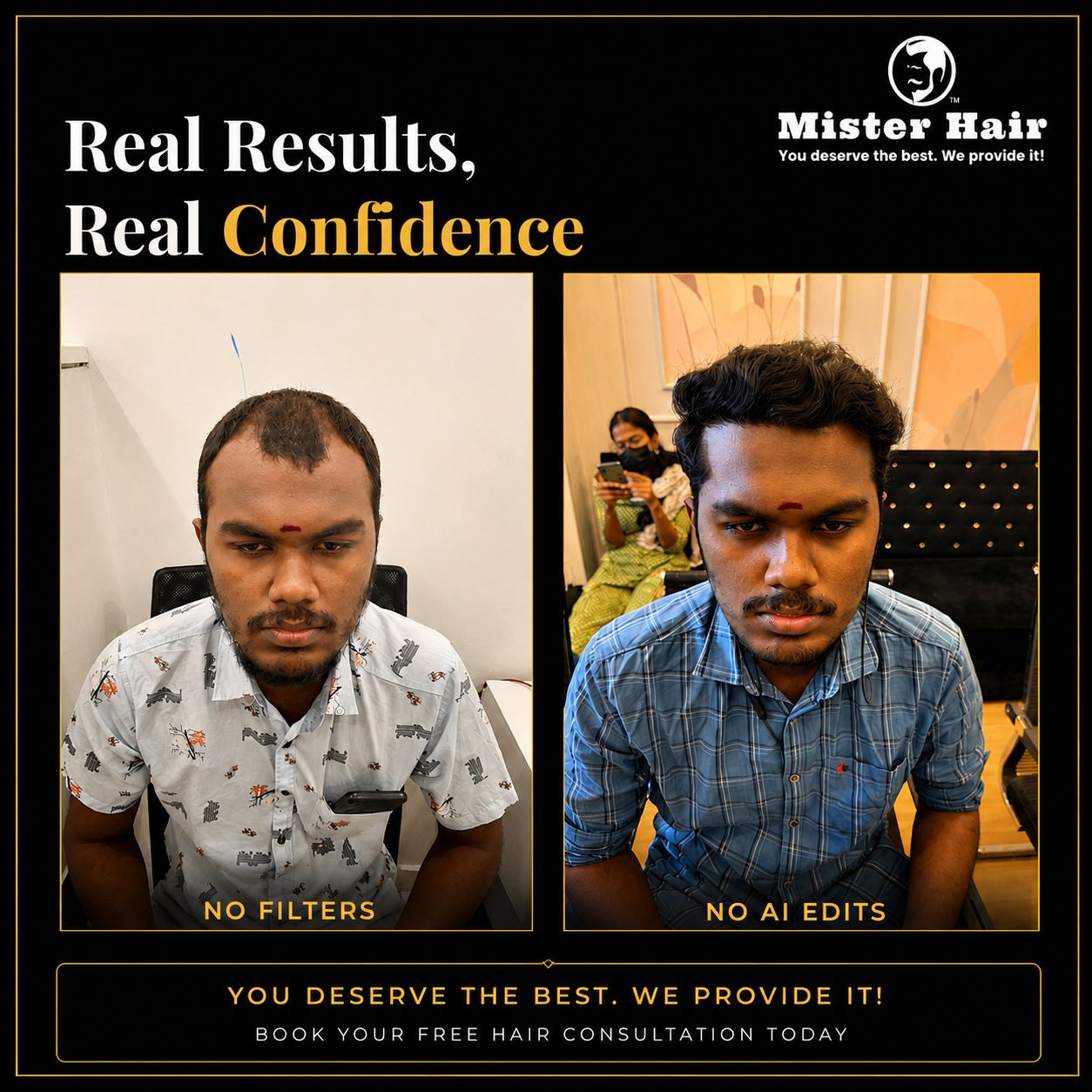 Before and after hair transplant result 4