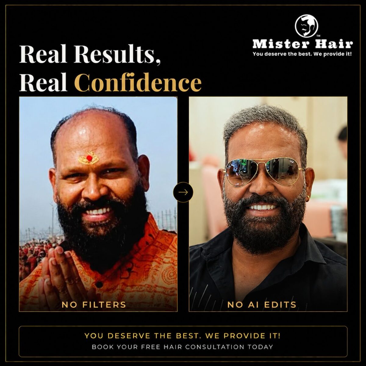 Hair Transplant in Bangalore — DHI & Sapphire FUE