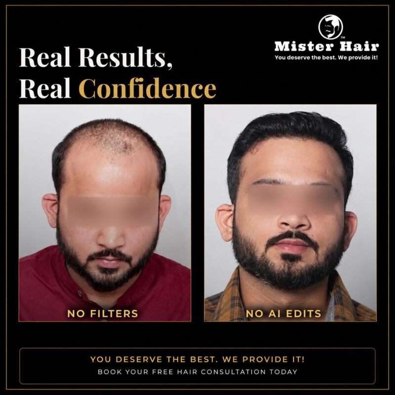 Hair transplant before and after result 6
