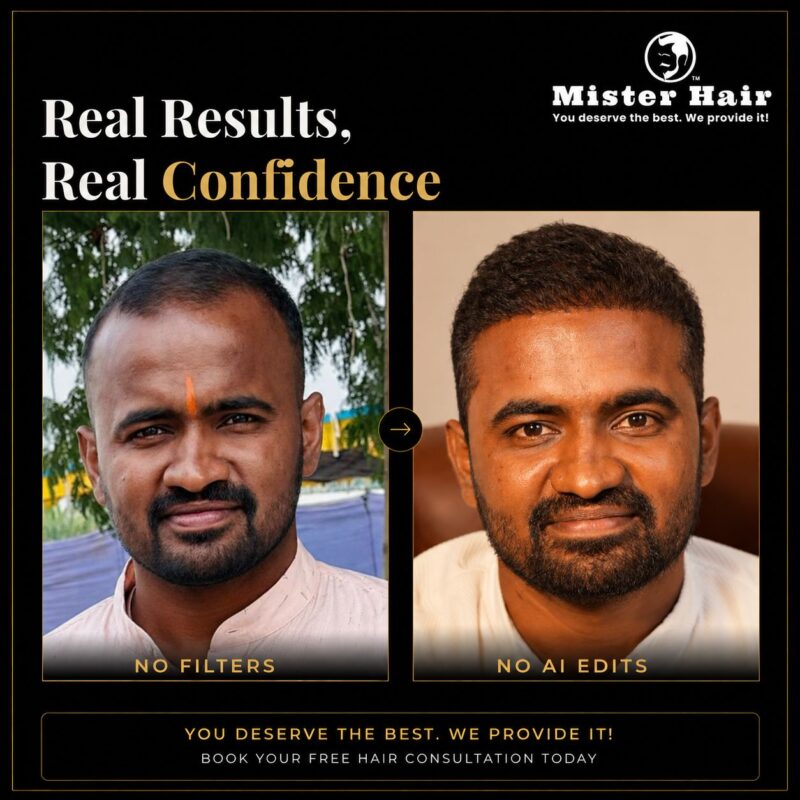 Hair transplant before and after result 7
