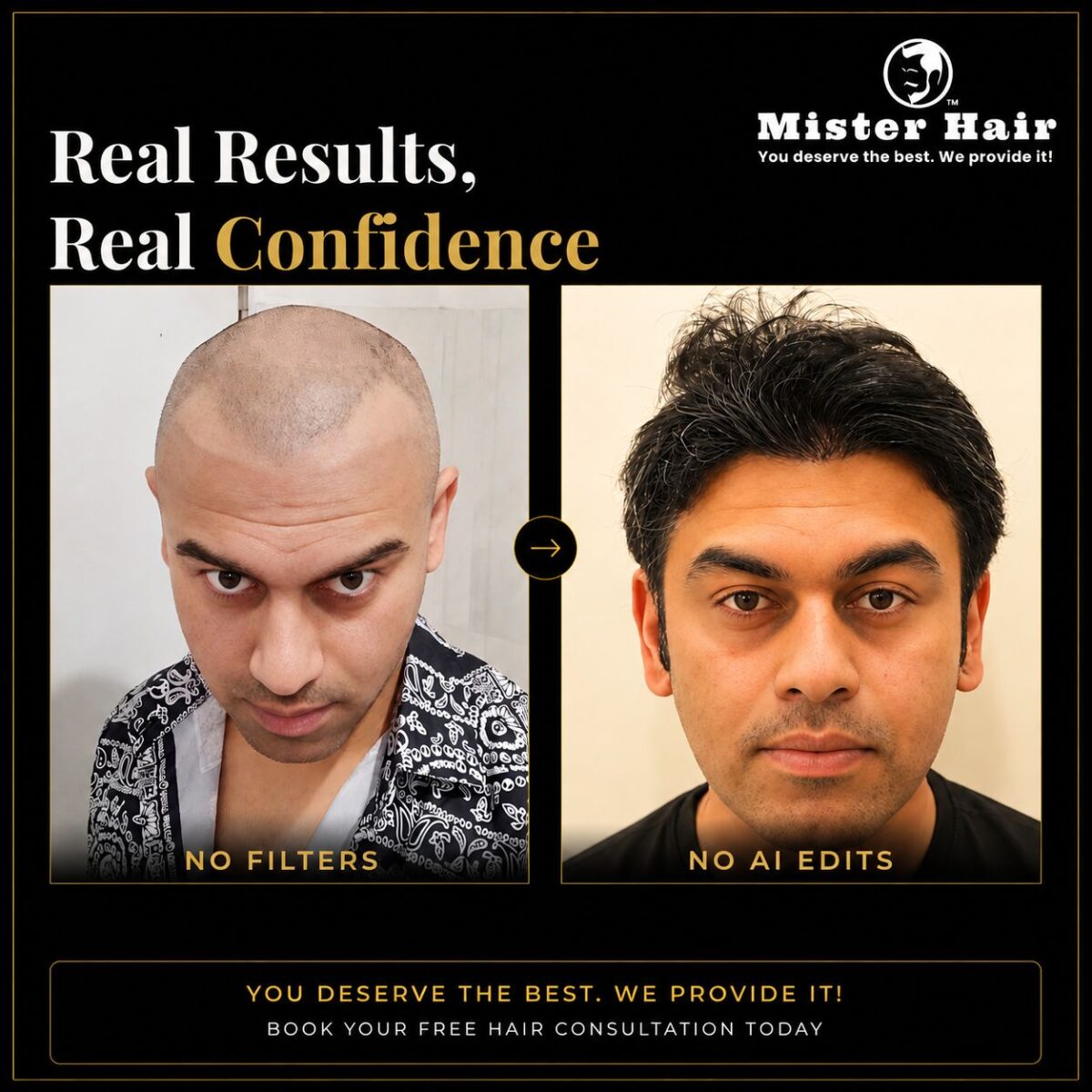 Beard & Eyebrow Transplant in Bangalore